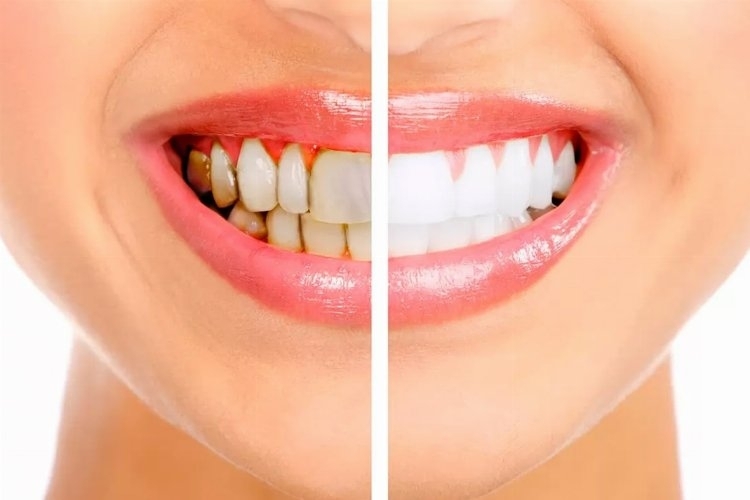 Diş Taşı Temizliğinin Sağlığa Etkileri: Zararları ve Faydaları