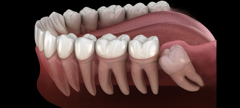 Gömülü Dişler Nasıl Tedavi Edilir?